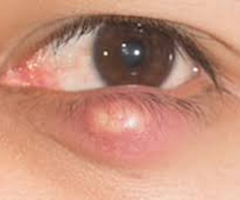 chalazion-la-copii
